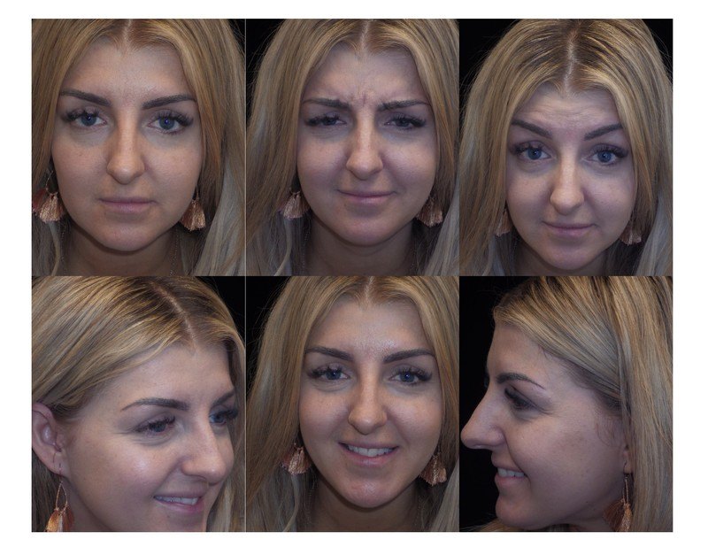 before after Cosmetic Injections in Salt Lake City, UT