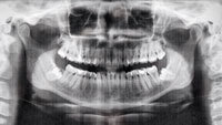 Dental X-Rays